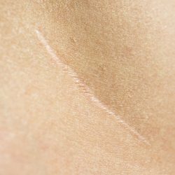 agent immunisantGros plan sur une cicatrice sur la peau, illustrant les étapes de la cicatrisation et les solutions naturelles pour atténuer les marques grâce aux huiles essentielles et végétales.