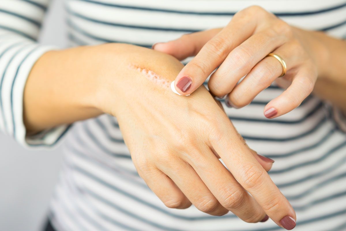 L'image représente une femme en train d'appliquer une crème sur ses cicatrices pour accélérer le processus de régénération de la peau. crème cicatrisante