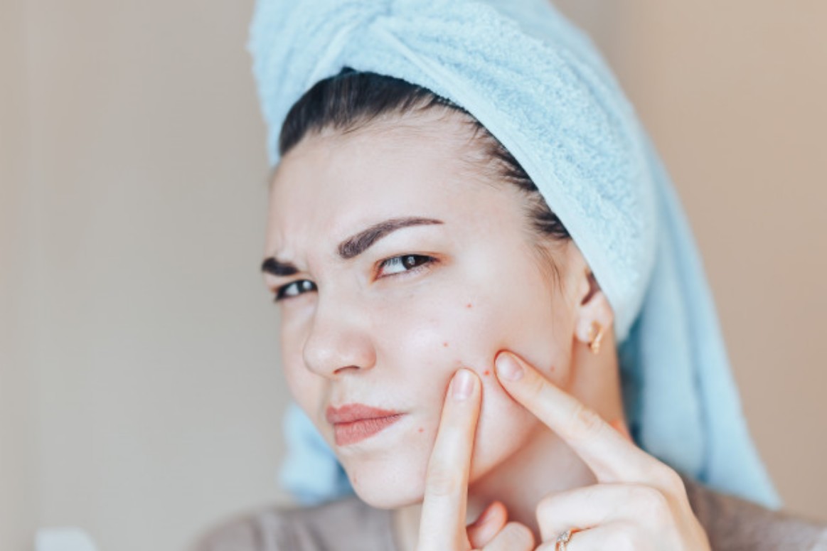 L'image représente une ado devant la glace en train de presser un de ses boutons.