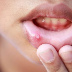 L'image représente une personne qui tient sa lèvre inférieure pour montrer qu'elle a un aphte.