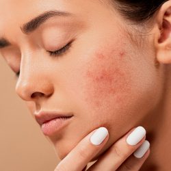L'image représente une femme souffrant d'acné. Elle présente de nombreuses papules rouges sur les joues.