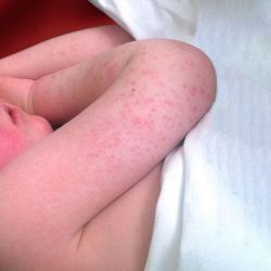 la photo représente un enfant atteint de scarlatine. ses joues sont très rouges. scarlatine et plantes médicinales