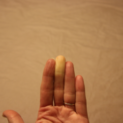 L'acrocyanose et le syndrome de Raynaud