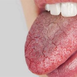 L'image représente la langue d'une personne atteinte de la maladie de Gougerot-Sjögren une personne atteinte, qui tire la langue