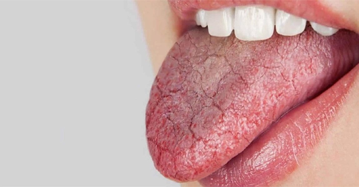 L'image représente la langue d'une personne atteinte de la maladie de Gougerot-Sjögren une personne atteinte, qui tire la langue