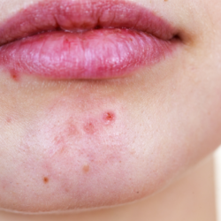 Maskné De l'acné sous mon masque