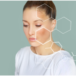 comment éviter le masque de grossesse, mélasma, hyperpigmentation, taches