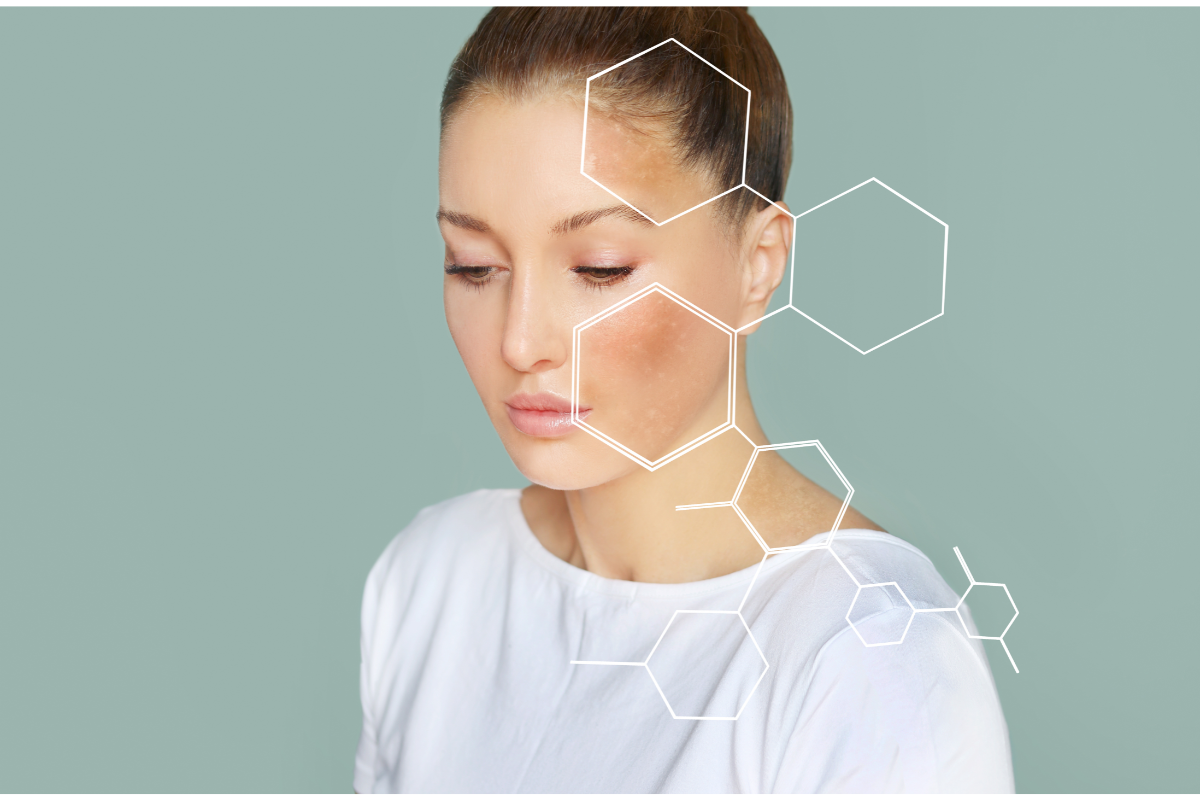 comment éviter le masque de grossesse, mélasma, hyperpigmentation, taches