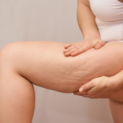 Une femme en sous-vêtements blancs pince doucement la peau de sa cuisse, indiquant la présence de cellulite, souvent associée à la rétention d'eau, un problème courant que des traitements comme le B O P peuvent cibler