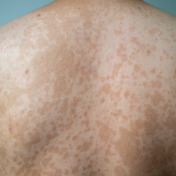 l'image représente le dos d'un homme atteint de Pityriasis versicolor