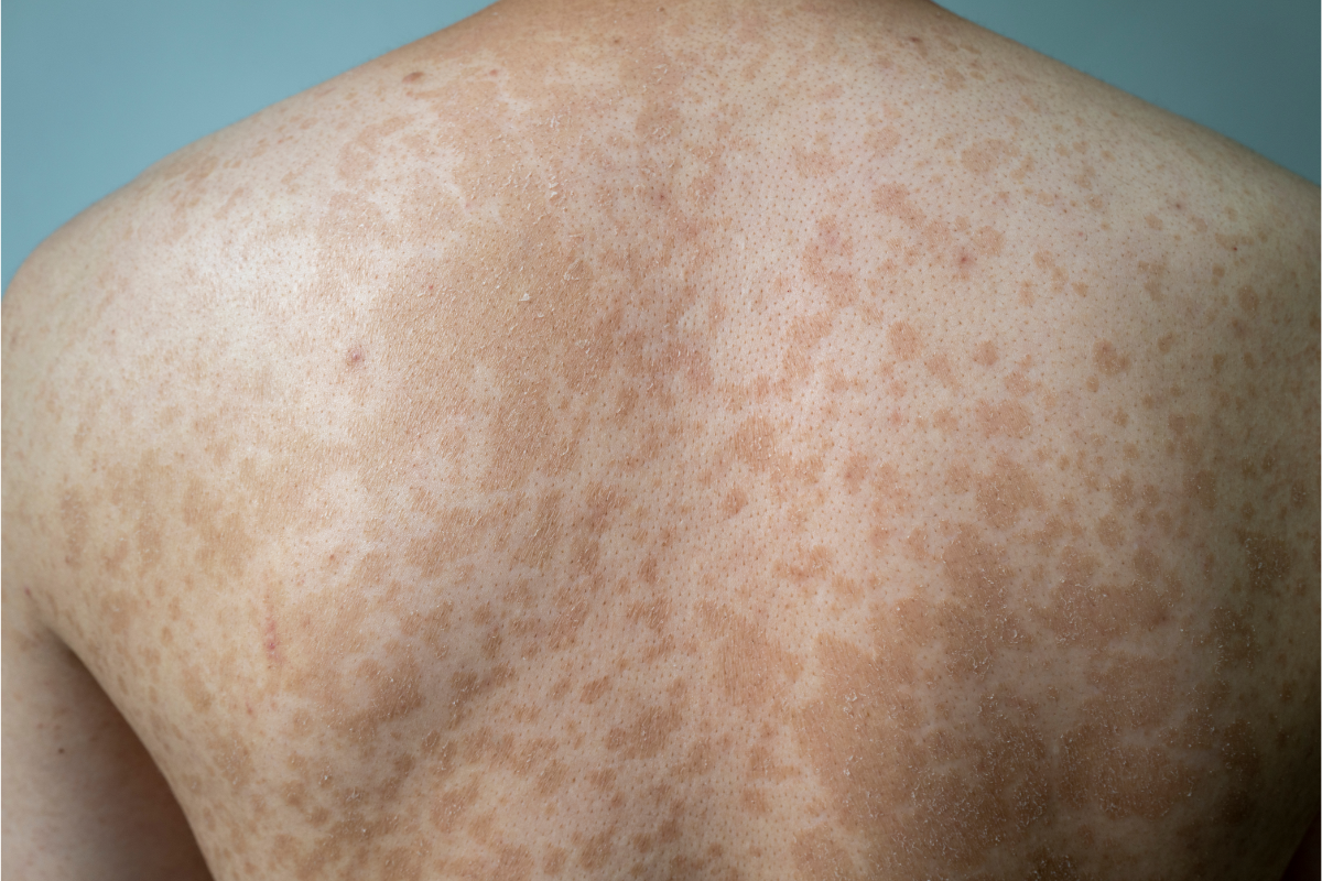 l'image représente le dos d'un homme atteint de Pityriasis versicolor