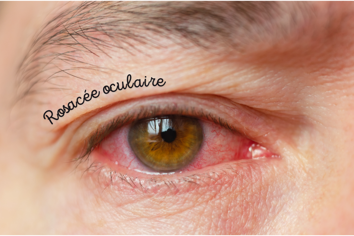 Œil atteint de rosacée oculaire avec rougeurs et inflammation de la paupière
