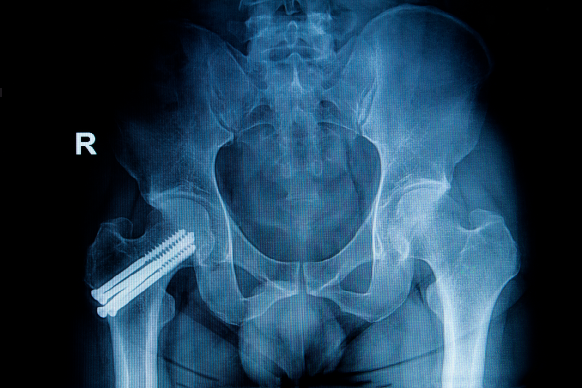 Radiographie d'une hanche montrant une fracture réparée avec des implants, illustrant l'importance de la régénération et de la densité osseuse. Le Shilajit, riche en nutriments essentiels tels que le calcium et les acides fulviques, favorise la cicatrisation osseuse, renforce les os et aide à prévenir l'ostéoporose, soutenant ainsi une meilleure santé osseuse.