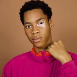 Jeune homme avec vitiligo autour de l'œil, représentant les bienfaits des compléments naturels pour le traitement du vitiligo.