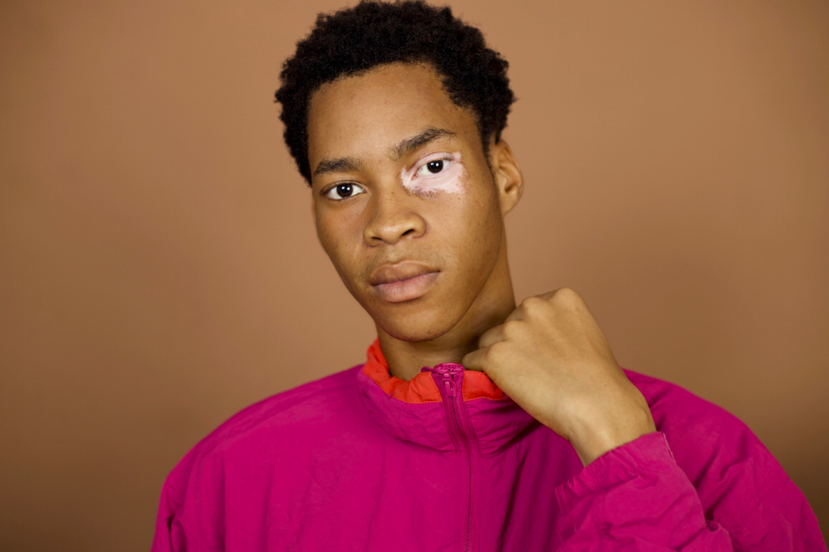 Jeune homme avec vitiligo autour de l'œil, représentant les bienfaits des compléments naturels pour le traitement du vitiligo.