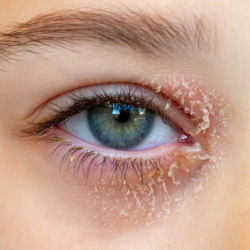 Gros plan sur un œil atteint d’eczéma des paupières, avec des rougeurs, desquamations et inflammation visible sur la peau sensible.